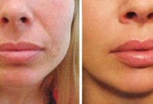 lip fillers west palm beach