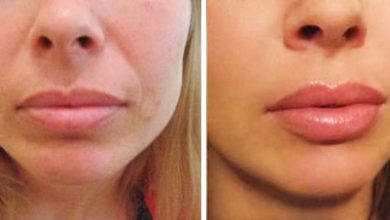 lip fillers west palm beach