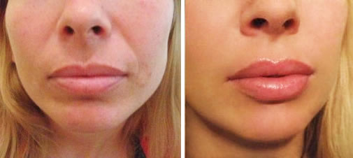 lip fillers west palm beach